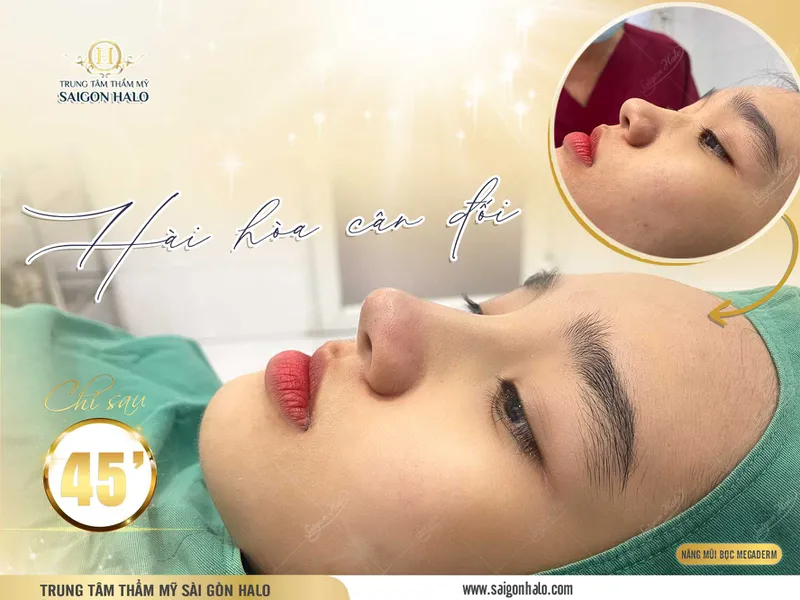 Những lưu ý cần nắm rõ trước và sau khi đi nâng mũi cho người mới