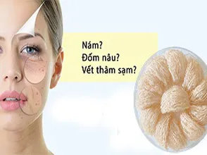 Yến sào giúp điều trị nám da