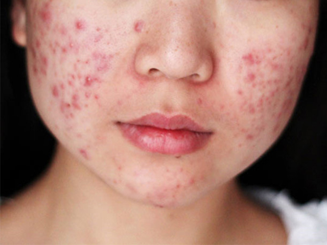 tham-mun-nguyen-nhan-va-cach-khac-phuc-vet-tham-mun tham-mun-nguyen-nhan-va-cach-khac-phuc-vet-tham-mun