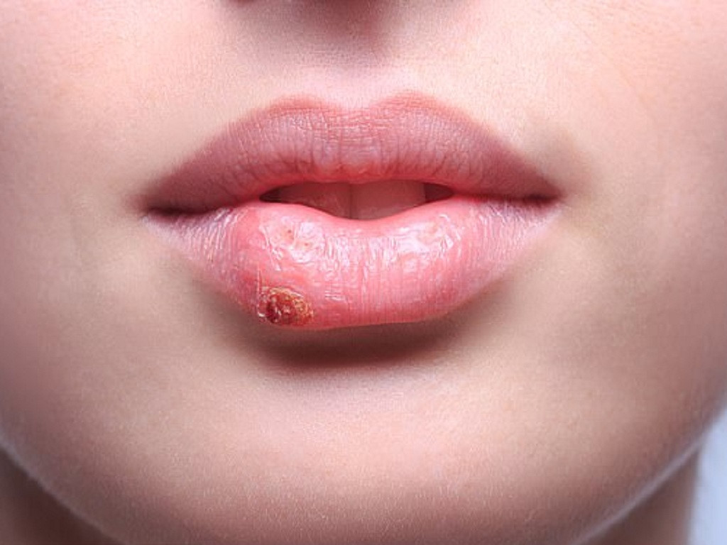 kho-moi-va-cac-cach-tri-kho-moi-hieu-qua kho-moi-va-cac-cach-tri-kho-moi-hieu-qua