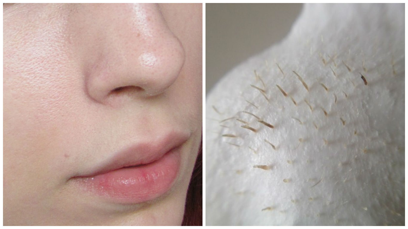 phuong-phap-loai-bo-mun-dau-den-o-vung-mui phuong-phap-loai-bo-mun-dau-den-o-vung-mui