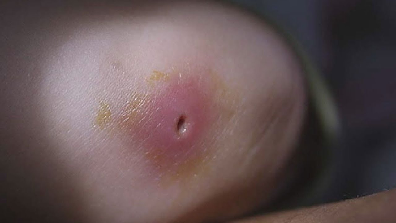 mun-dinh-rau-nguyen-nhan-va-cach-khac-phuc-hieu-qua mun-dinh-rau-nguyen-nhan-va-cach-khac-phuc-hieu-qua