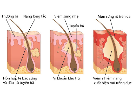 co-nen-lay-nhan-mun-khong-lay-nhan-mun-chuan-y-khoa-tai-nha-nhu-the-nao-cham-soc-da-sau-khi-lay-nhan-mun co-nen-lay-nhan-mun-khong-lay-nhan-mun-chuan-y-khoa-tai-nha-nhu-the-nao-cham-soc-da-sau-khi-lay-nhan-mun
