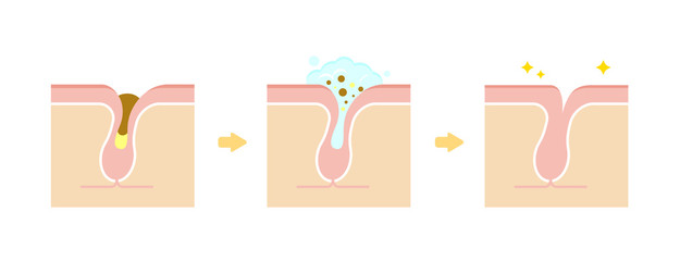 mun-dau-den-nguyen-nhan-va-cach-dieu-tri-hieu-qua mun-dau-den-nguyen-nhan-va-cach-dieu-tri-hieu-qua