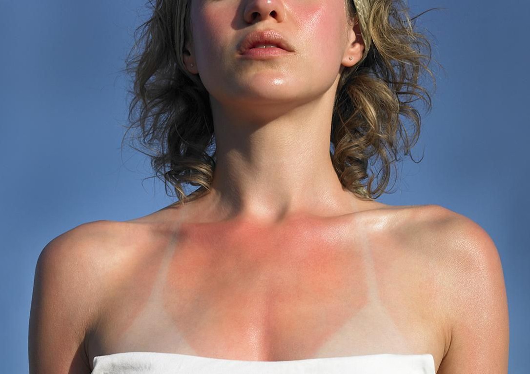 chay-nang-cach-khac-phuc-tinh-trang-da-chay-nang-va-phuc-hoi-da-chay-nang chay-nang-cach-khac-phuc-tinh-trang-da-chay-nang-va-phuc-hoi-da-chay-nang