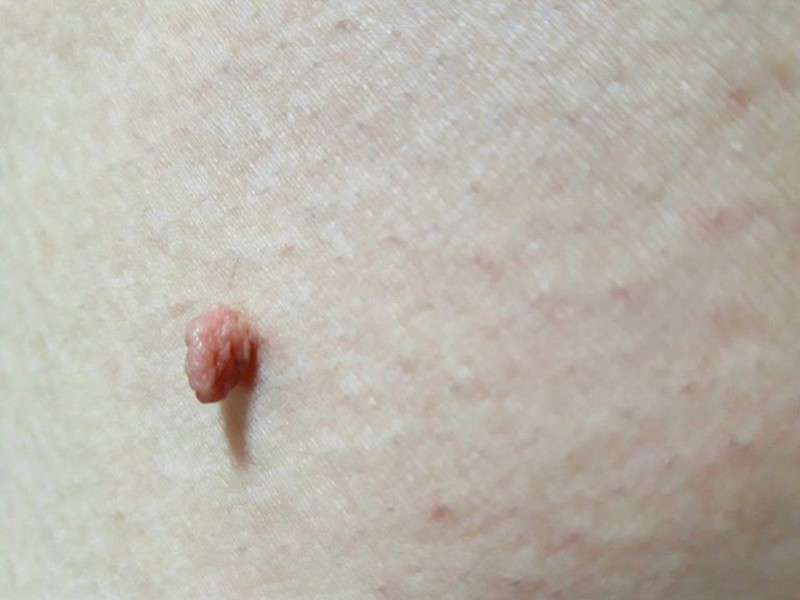 cach-chua-tri-mun-thit-hieu-qua-ma-khong-ton-kem cach-chua-tri-mun-thit-hieu-qua-ma-khong-ton-kem