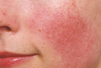 ban-biet-nhung-dieu-gi-ve-lan-da-nhay-camban-biet-nhung-dieu-gi-ve-lan-da-nhay-cam ban-biet-nhung-dieu-gi-ve-lan-da-nhay-cam