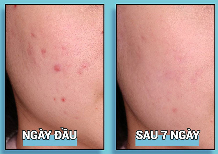 gel-tri-mun-va-phuc-hoi-cho-da-bi-mun-hanyul-mentha-trouble-spot-gel gel-tri-mun-va-phuc-hoi-cho-da-bi-mun-hanyul-mentha-trouble-spot-gel