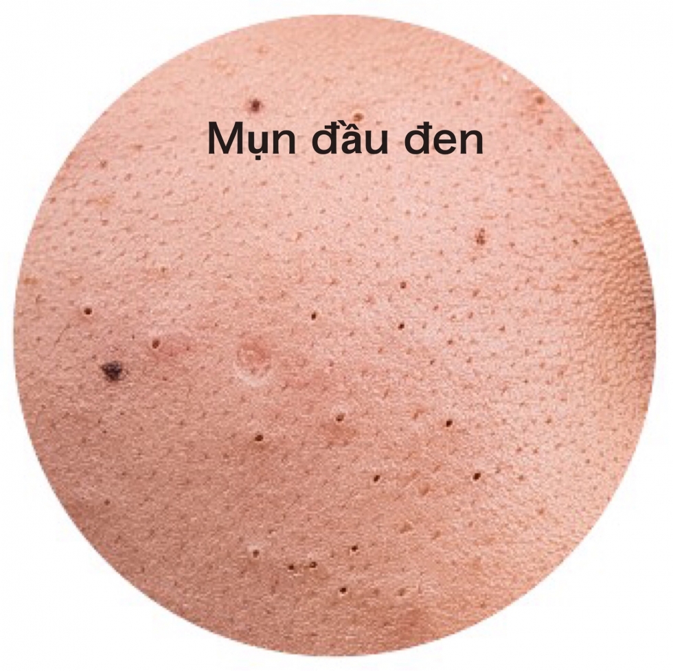 phuong-phap-loai-bo-mun-dau-den-o-vung-mui phuong-phap-loai-bo-mun-dau-den-o-vung-mui