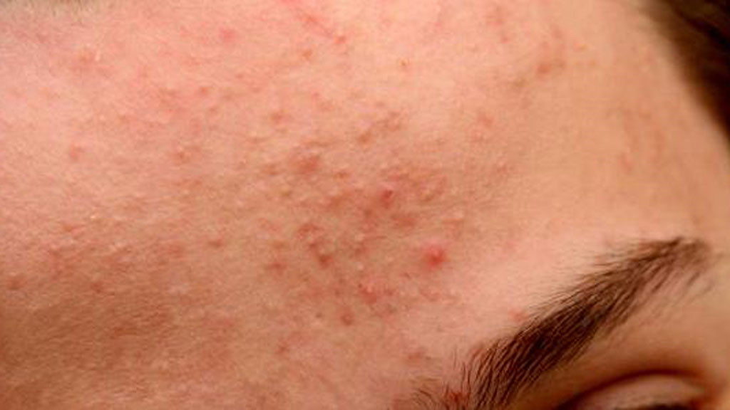 cach-tot-nhat-de-loai-tru-mun-an-mun-tac-ngen cach-tot-nhat-de-loai-tru-mun-an-mun-tac-ngen