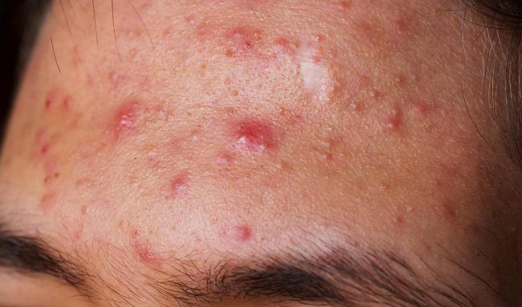 mun-boc-sung-do-la-gi-cach-tri-mun-boc-sung-do mun-boc-sung-do-la-gi-cach-tri-mun-boc-sung-do