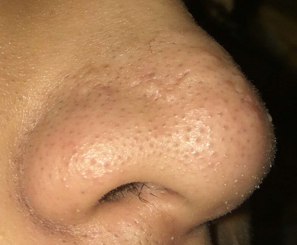 phuong-phap-loai-bo-mun-dau-den-o-vung-mui phuong-phap-loai-bo-mun-dau-den-o-vung-mui