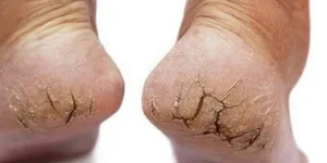 Nứt gót chân. Nguyên nhân và bí quyết khắc phục tình trạng nứt gót chân
