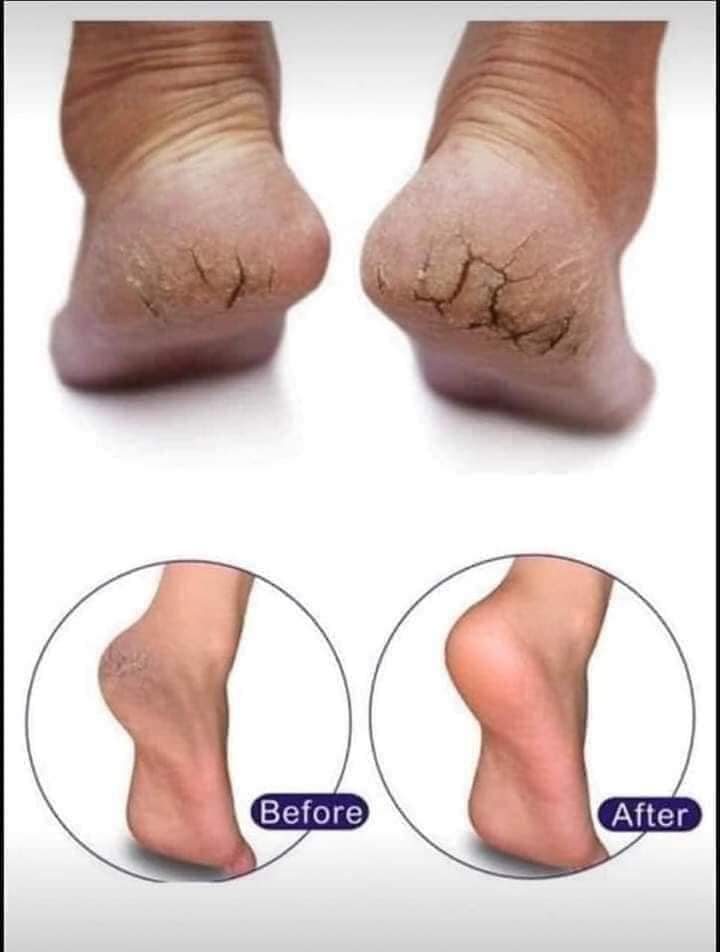 Kem trị nứt gót chân Scholl 24h Anti-Crack Heel Cream