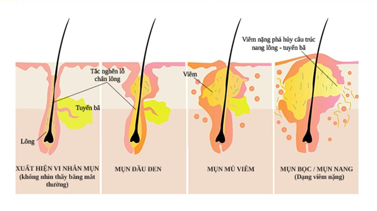 mun-boc-sung-do-la-gi-cach-tri-mun-boc-sung-do mun-boc-sung-do-la-gi-cach-tri-mun-boc-sung-do