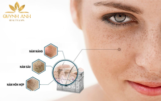 Các loại nám da, dấu hiệu nhận biết và cách điều trị nám da hiệu quả