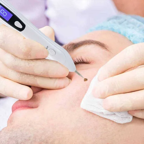 Đốt mụn ruồi siêu nhanh cùng laser CO2 Fractional