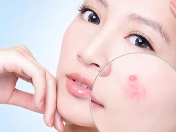 'Bí kíp' điều trị mụn hiệu quả mùa nắng nóng