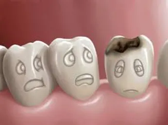 Sâu răng và lựa chọn nhổ bỏ hay bảo tồn