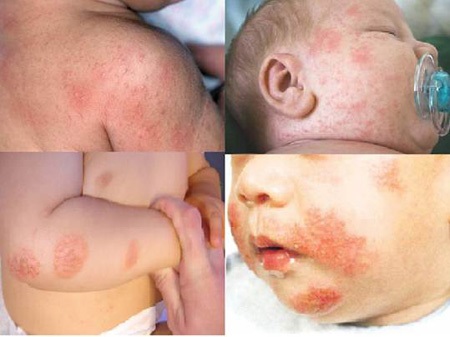 Nếu không chữa trị kịp thời rôm sảy sẽ chuyển sang mụn nhọt và khó chữa trị