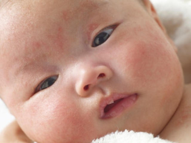 Trẻ nhỏ sức đề kháng yếu nên thường dễ mắc bệnh liên quan đường hô hấp nhất là rôm sảy