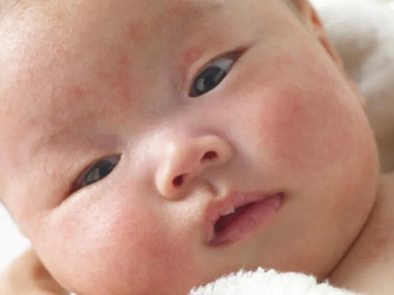 Triệu chứng, hậu quả và cách trị rôm sẩy cho bé nhanh nhất