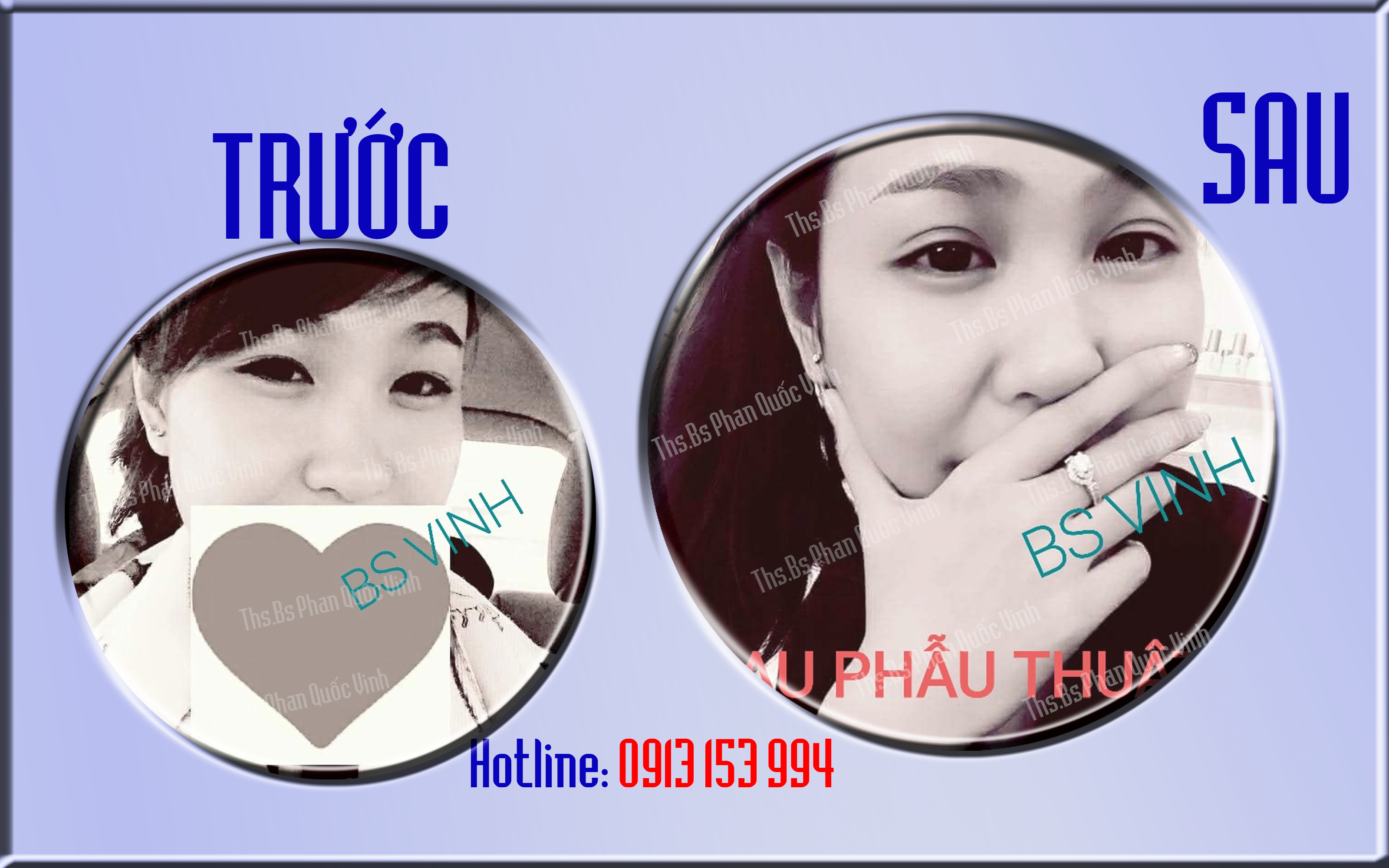 CẮT MÍ MẮT - NHẤN MÍ MẮT - THẨM MỸ MẮT - THẨM MỸ VIỆN QUỐC VINH - PHẪU THUẬT THẨM MỸ ĐẸP