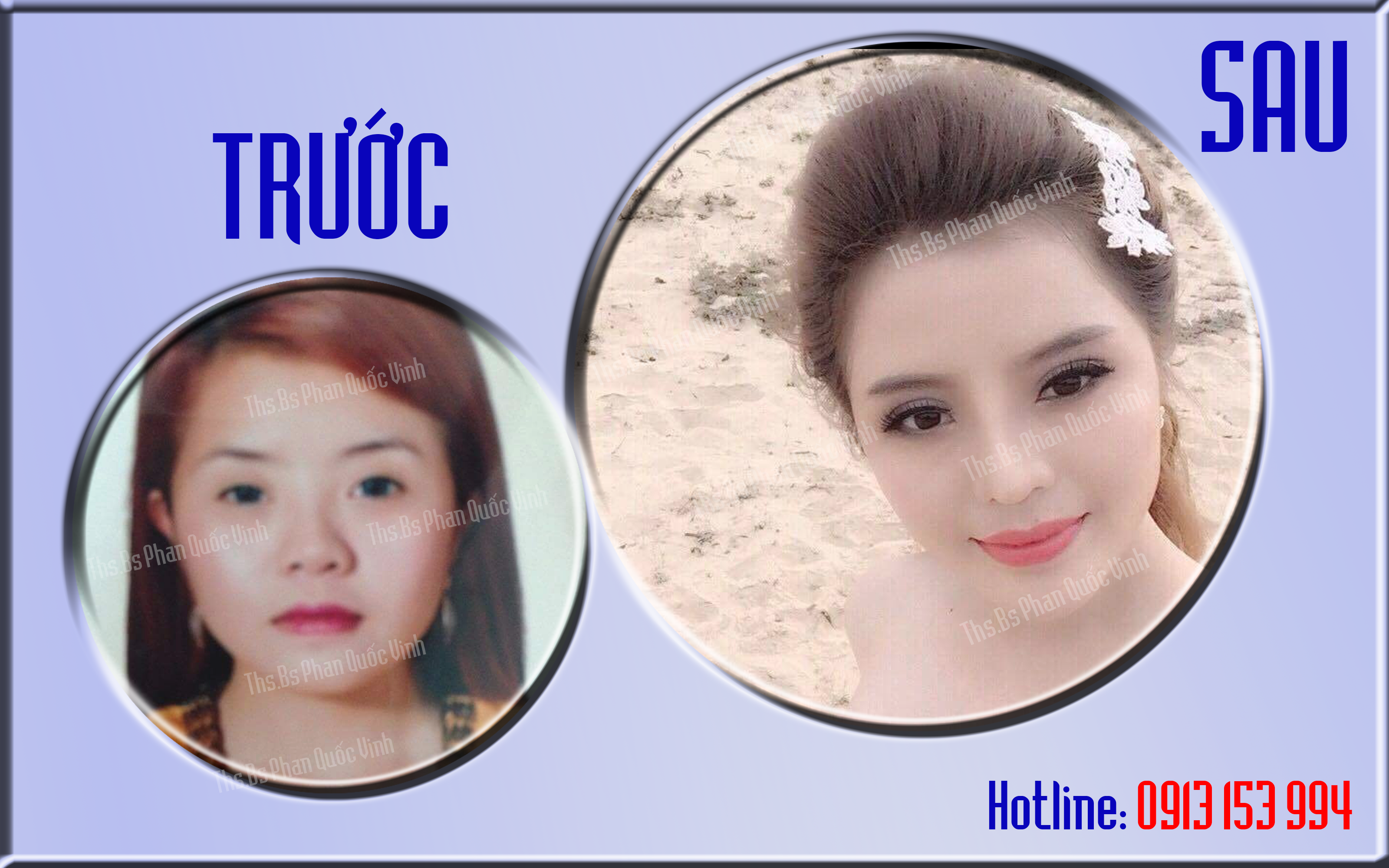 Thẩm mỹ viện Quốc Vinh - Phẫu thuật thẩm mỹ đẹp - Độn cằm Vline đẹp