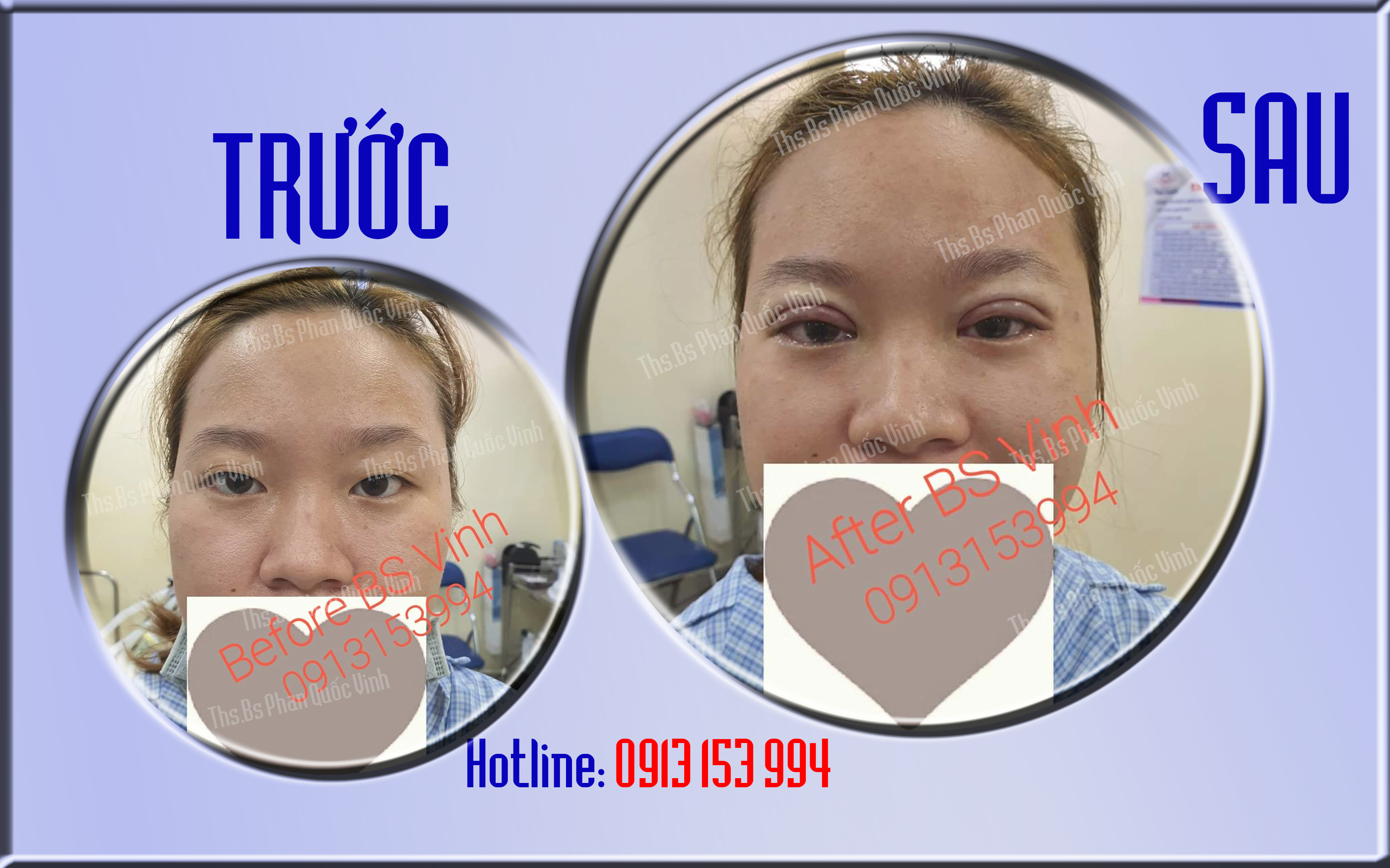 CẮT MÍ MẮT - NHẤN MÍ MẮT - THẨM MỸ MẮT - THẨM MỸ VIỆN QUỐC VINH - PHẪU THUẬT THẨM MỸ ĐẸP