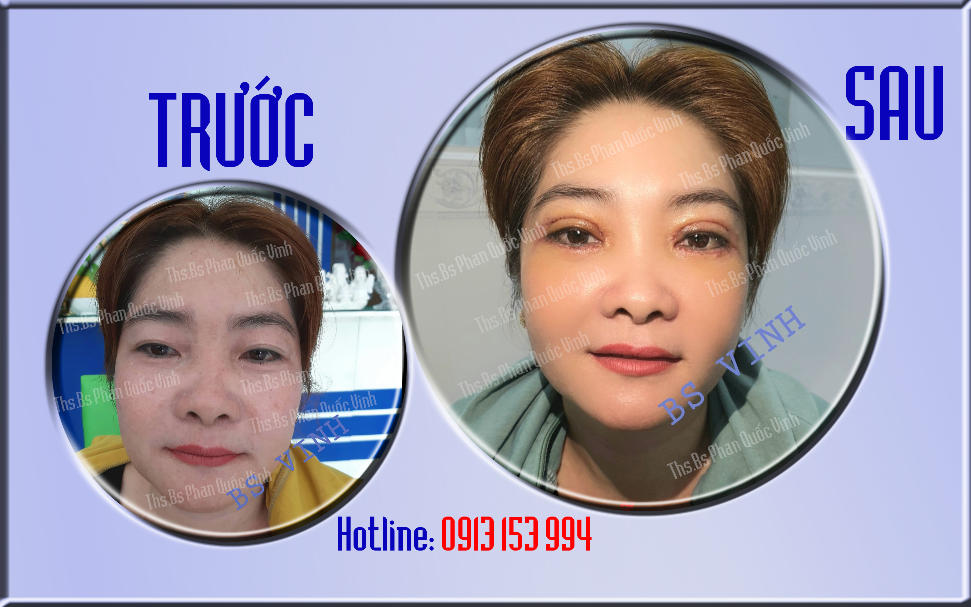 CẮT MÍ MẮT - NHẤN MÍ MẮT - THẨM MỸ MẮT - THẨM MỸ VIỆN QUỐC VINH - PHẪU THUẬT THẨM MỸ ĐẸP