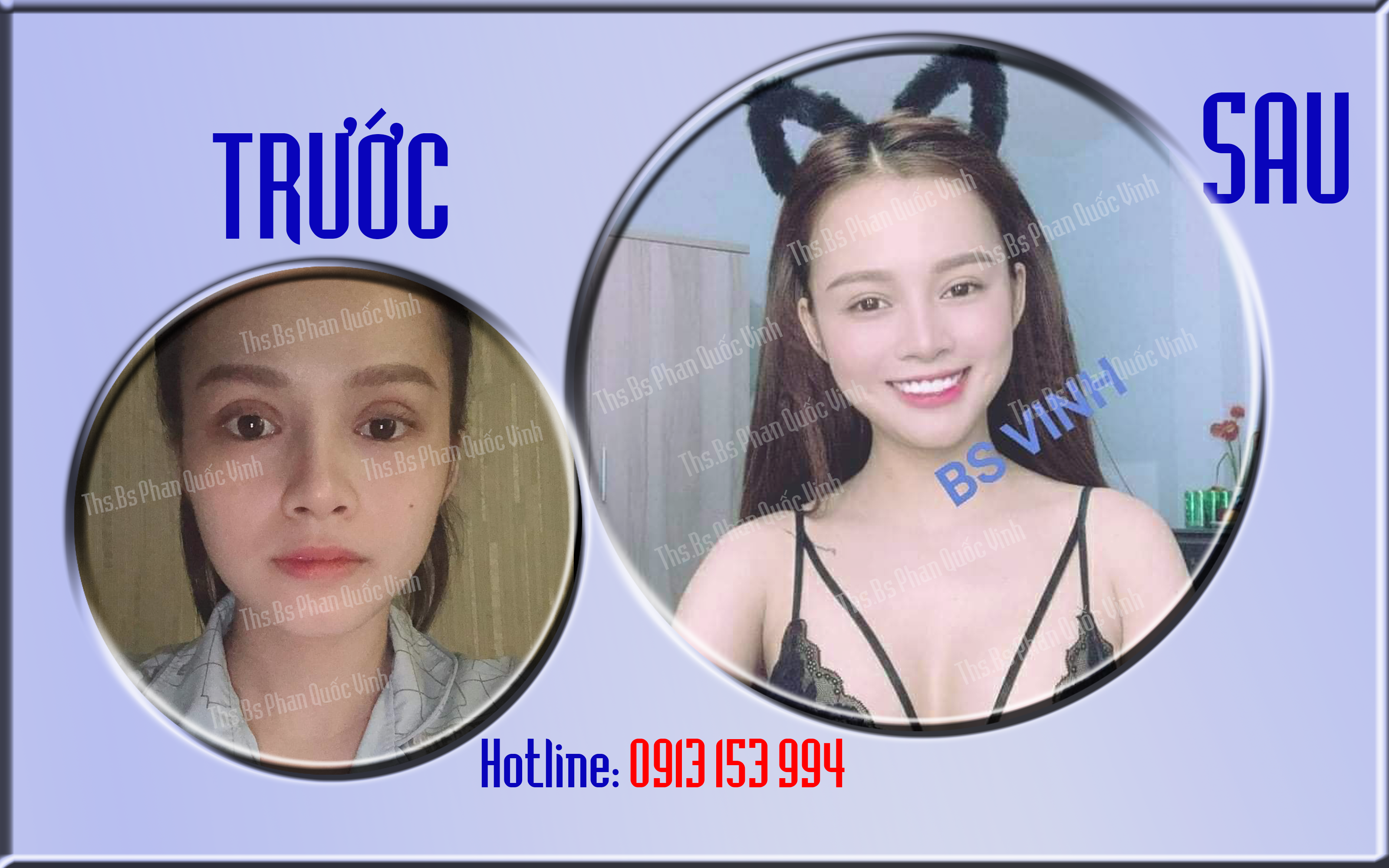 CẮT MÍ MẮT - NHẤN MÍ MẮT - THẨM MỸ MẮT - THẨM MỸ VIỆN QUỐC VINH - PHẪU THUẬT THẨM MỸ ĐẸP