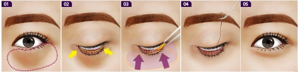 CẮT MÍ DƯỚI - LẤY MỠ VÀ DA THỪA MI DƯỚI - THẨM MỸ VIỆN QUỐC VINH