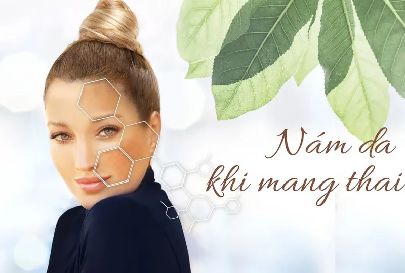 Nám da khi mang thai