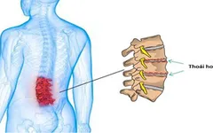 THOÁI HÓA CỘT SỐNG – NGUY HIỂM TIỀM TÀNG