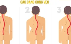 Tác hại của cong vẹo cột sống như thế nào bạn có biết?