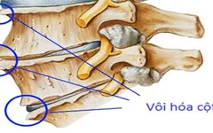 VÔI HÓA CỘT SỐNG – BỆNH LÝ XƯƠNG KHỚP CẦN CẢNH GIÁC