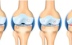 THOÁI HÓA KHỚP GỐI LÀ GÌ? SAO NÓ LẠI ÁM ẢNH NHIỀU NGƯỜI ĐẾN VẬY