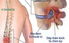 Các phương pháp điều trị thoát vị đĩa đệm
