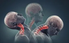 Bệnh thoái hóa cột sống cổ