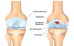 VIÊM ĐAU KHỚP GỐI ẢNH HƯỞNG NHƯ THẾ NÀO ?