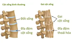 BỆNH GAI CỘT SỐNG LÀ GÌ? TRIỆU CHỨNG CỦA BỆNH GAI CỘT SỐNG?