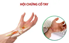 PHÒNG NGỪA HỘI CHỨNG ỐNG CỔ TAY