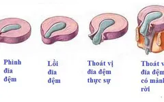THOÁT VỊ ĐĨA ĐỆM CỘT SỐNG THẮT LƯNG? NGUYÊN NHÂN???