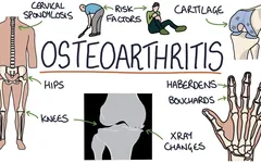 Những bệnh xương khớp thường gặp ở người Việt