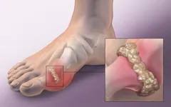 VẤN ĐỀ THƯỜNG GẶP Ở KHỚP GỐI