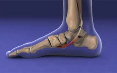 BÀN CHÂN BẸT - DỊ TẬT TRÊN CƠ THỂ NẾU KHÔNG CHÚ Ý