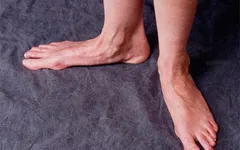 BÀN CHÂN BẸT Ở NGƯỜI LỚN VÀ TRIỆU CHỨNG