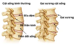 GAI CỘT SỐNG CÓ ĐÁNG SỢ VÀ BẠN CÓ MUỐN BIẾT VỀ NHỮNG BIẾN CHỨNG CỦA CĂN BỆNH NÀY? 