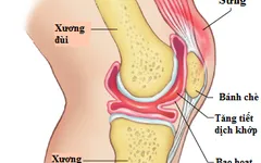 TRIỆU CHỨNG NHẬN BIẾT TRÀN DỊCH KHỚP GỐI