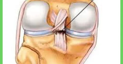 Tổn thương dây chằng chéo sau